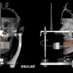 SAT3D plano oclusal en articulador
