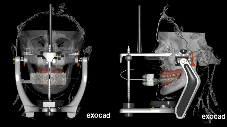 SAT3D plano oclusal en articulador