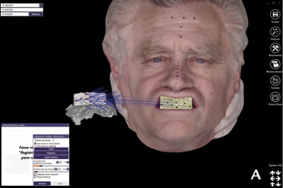 Escaneo_Implantes_3D